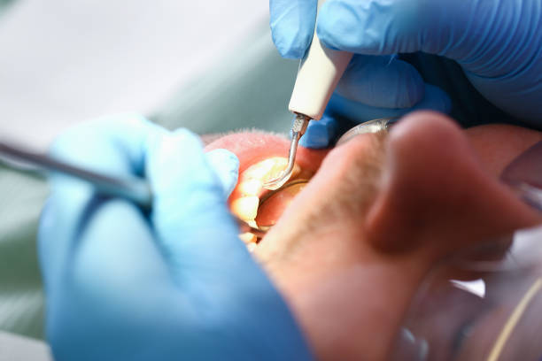 Best Knocked-Out Tooth (Avulsed Tooth) Treatment in Radcliff, KY